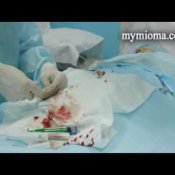 Эмболизация маточных артерий в Запорожье видео